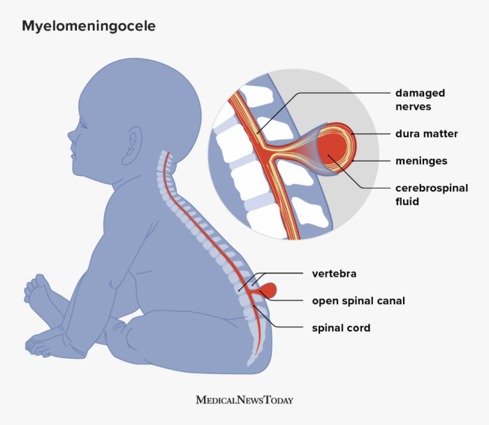 Translate the medical term myelomeningocele as literally as possible.